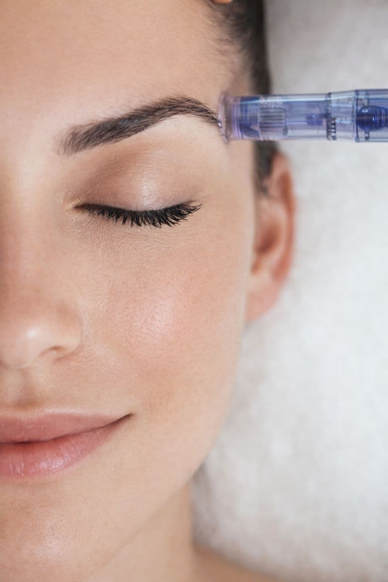 Regenerative glow microneedling met exosomen