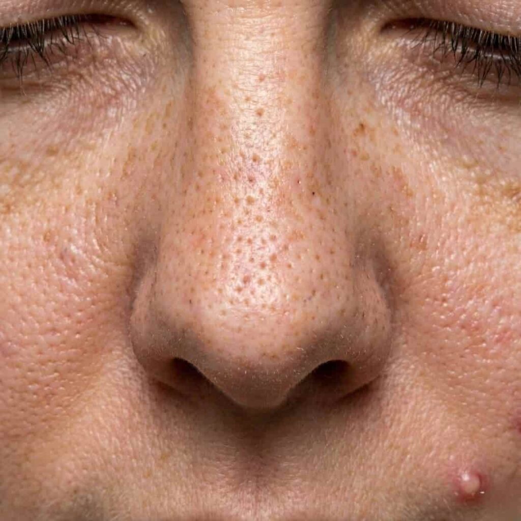 acne en grove porien