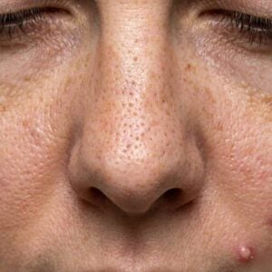 acne en grove porien