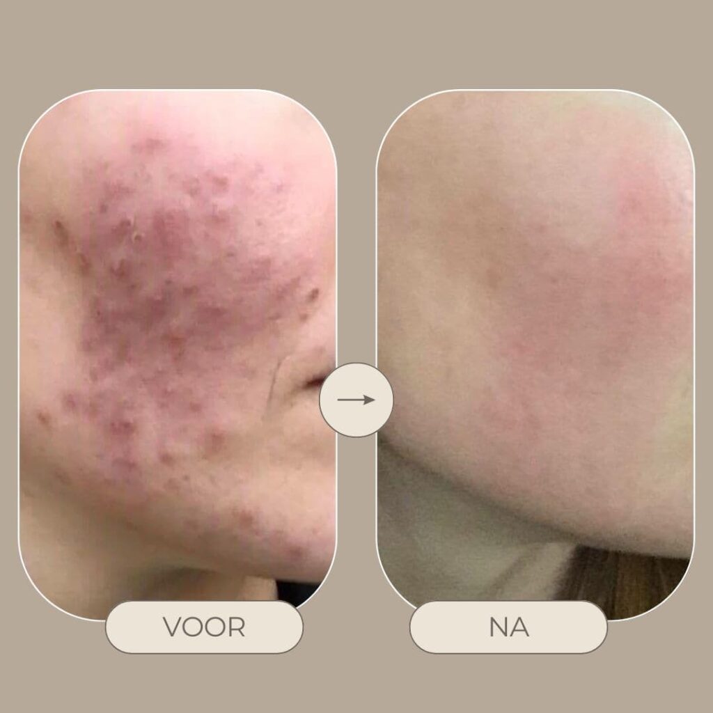 before en after bekijk resultaat