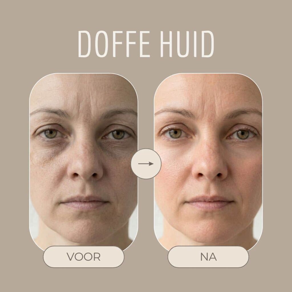 doffe huid before en after