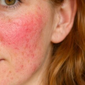 symptonen rosacea