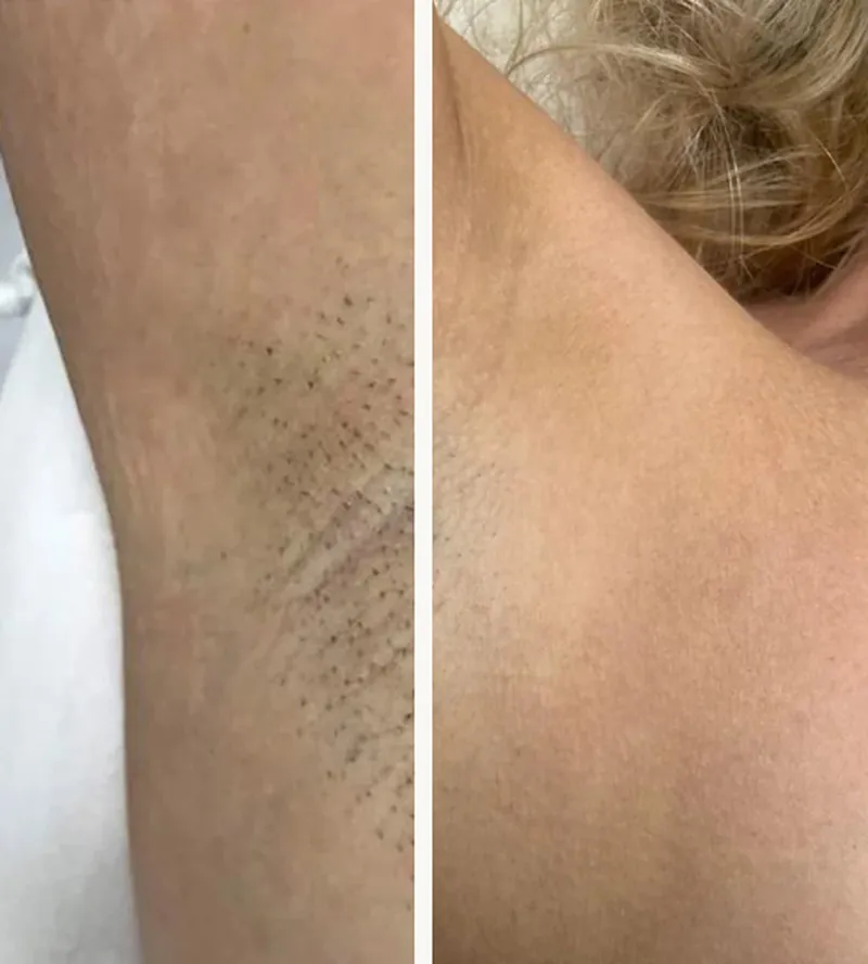 Oksel van een cliënt van Lalana: links voor de laserbehandelingen, rechts erna