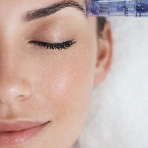 Regenerative glow microneedling met exosomen